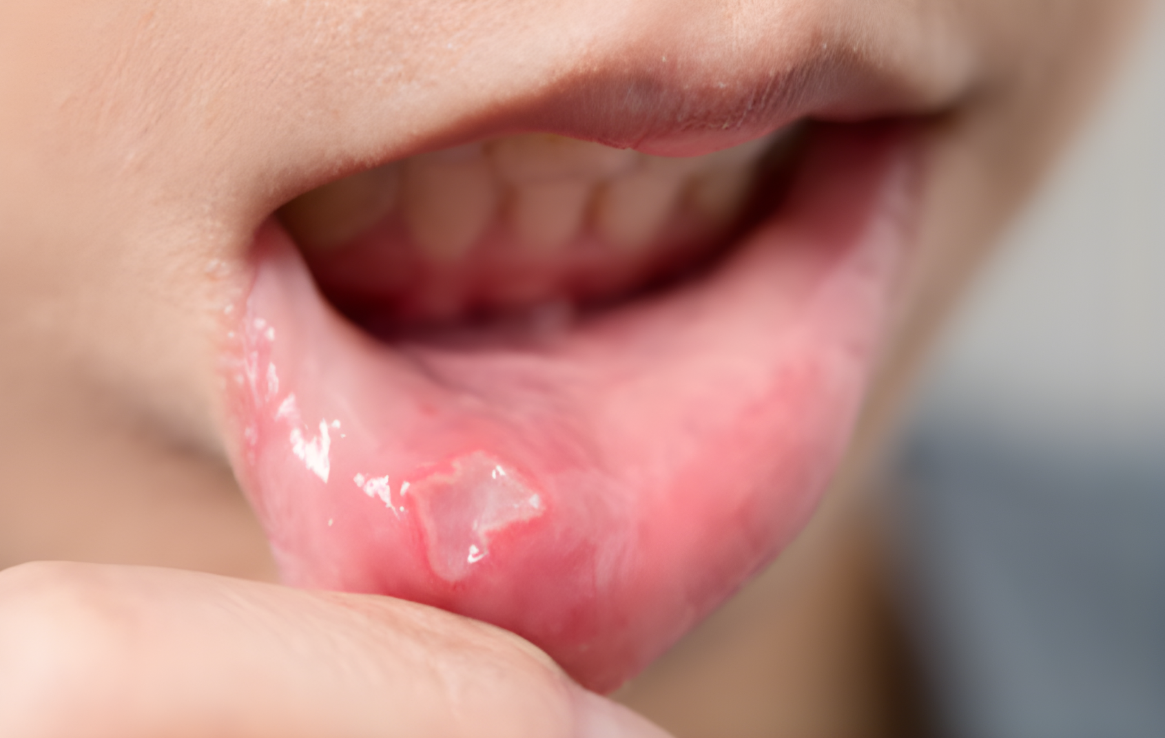 Aphthous stomatitis of the lower lip