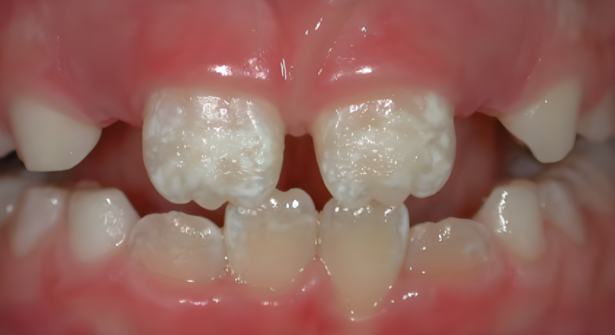 Hypoplastic enamel of the front teeth