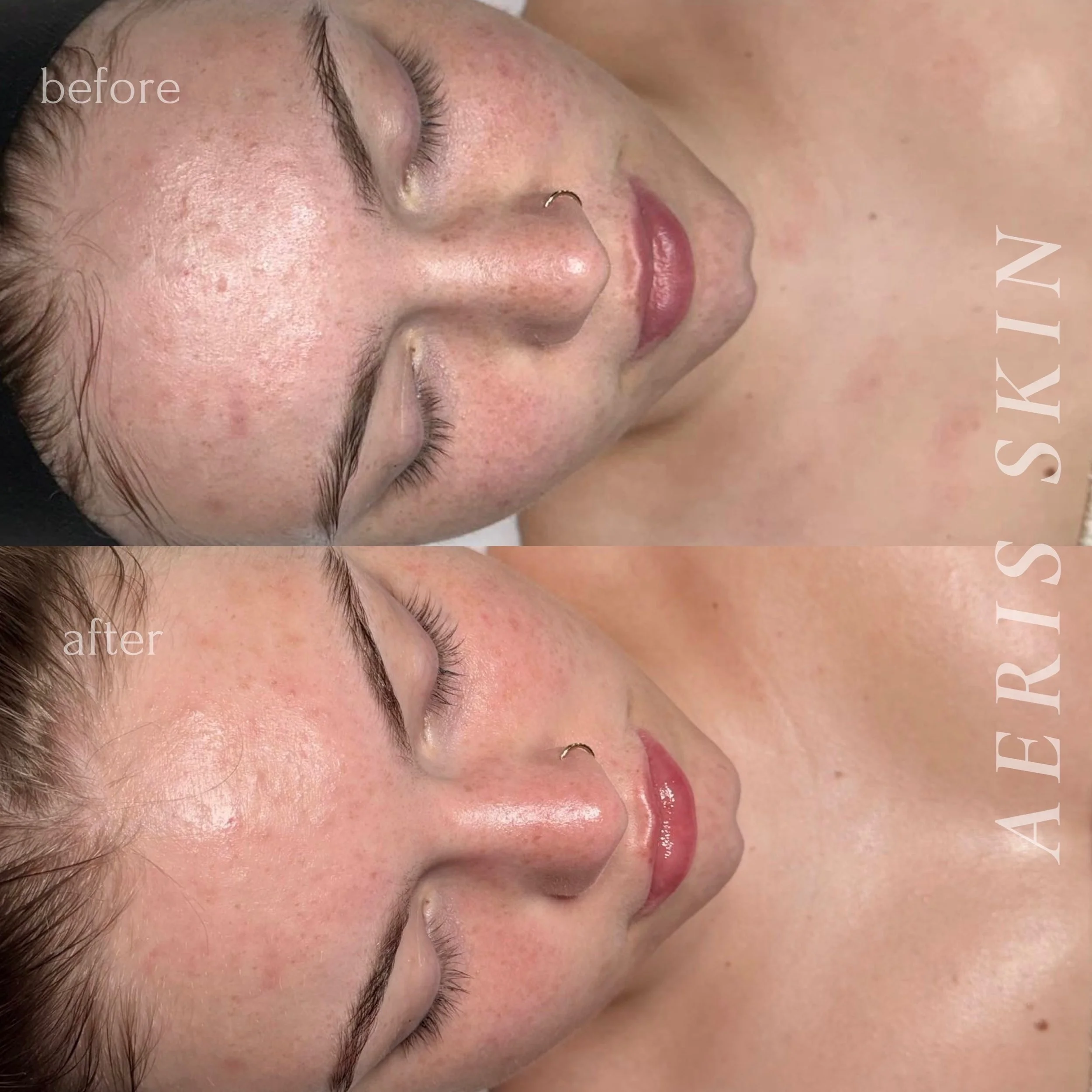 facial Vancouver Washington