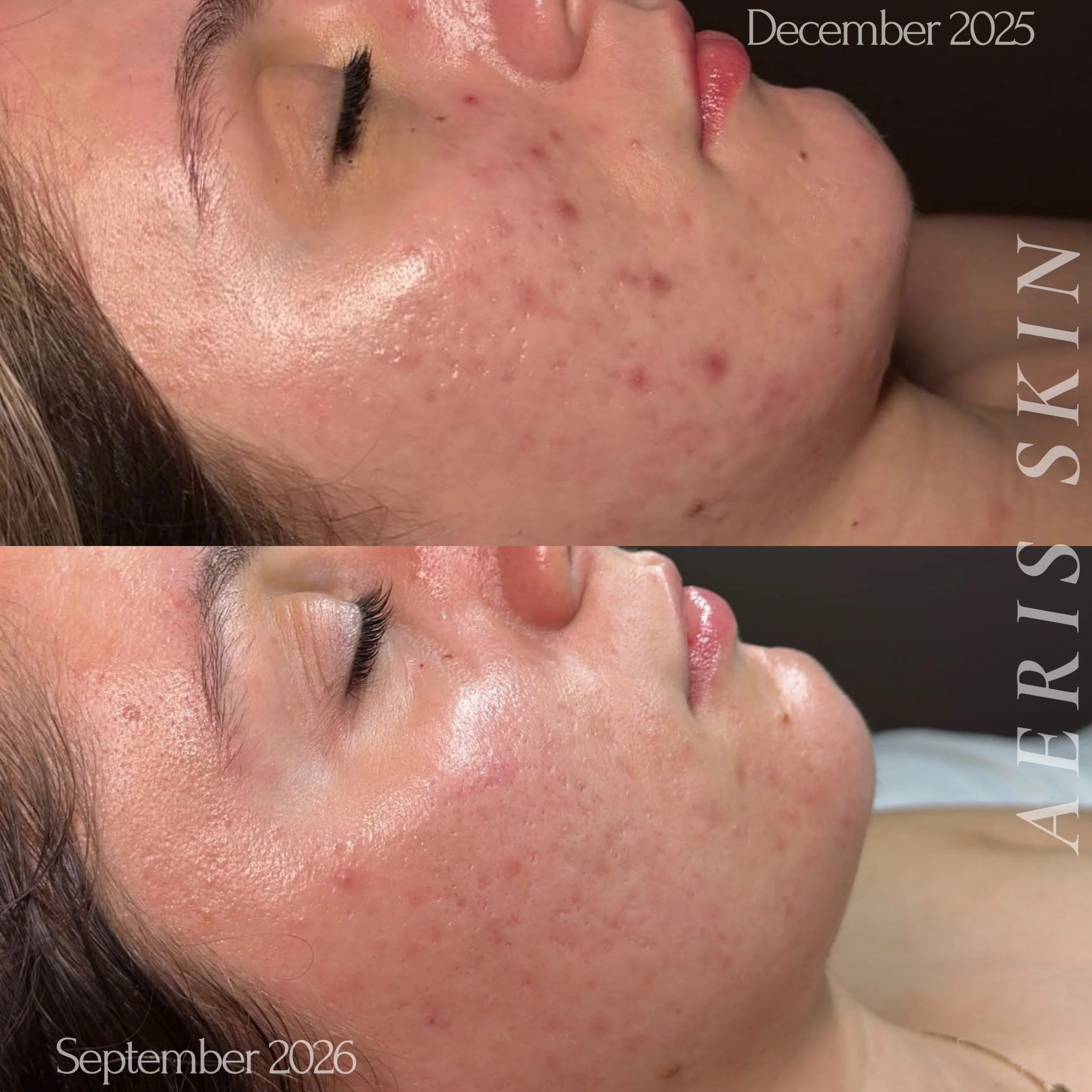 facial Vancouver Washington