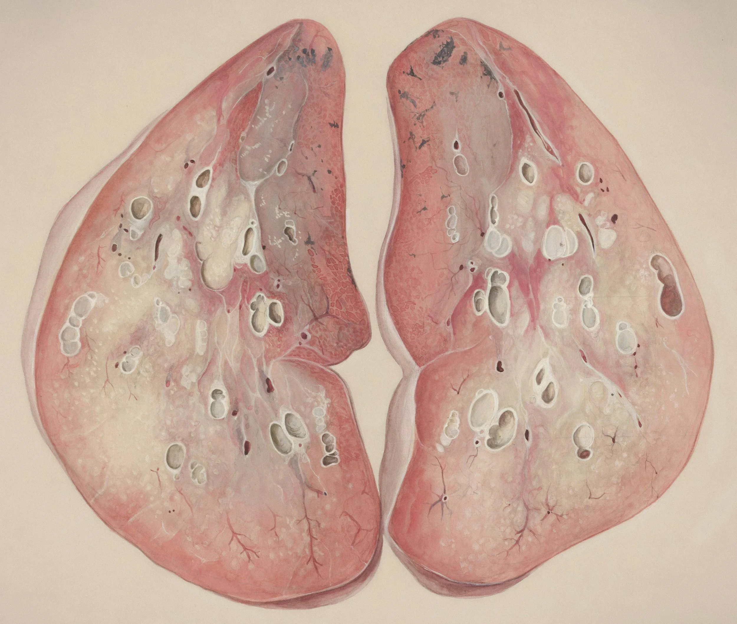  Lung tissue by Wetselaar-Whittaker, J, 1950/1990, Universitaire Bibliotheken Leiden, Dutch Collections for Europe, Netherlands. 