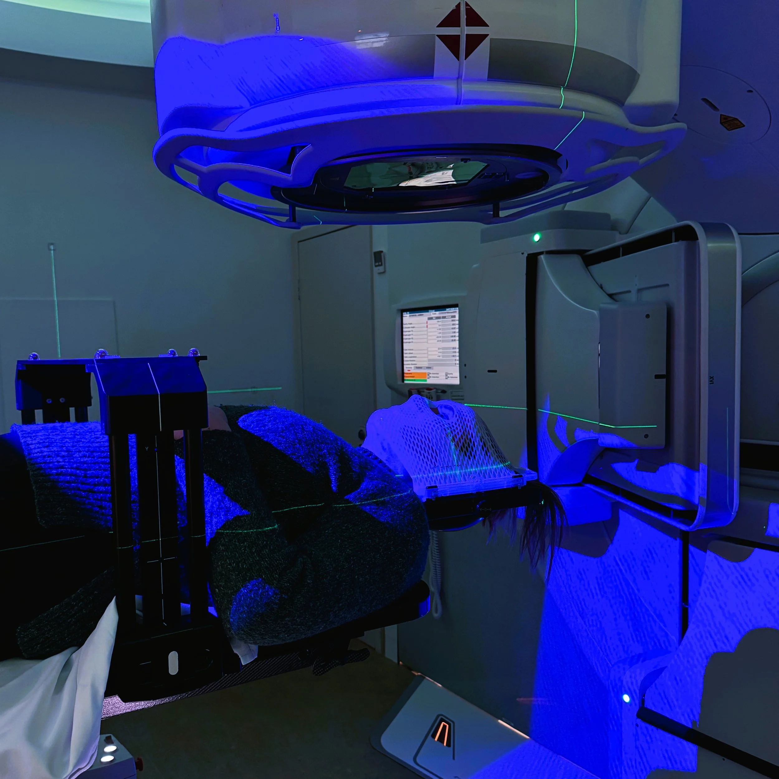 I am lying on a table, with my head wrapped in its custom-made radiation mask. The lasers are waking up, and my brain is about to be zapped.