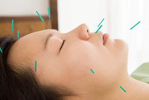 A person receiving acupuncture with multiple needles inserted into their face and neck while lying down with eyes closed.