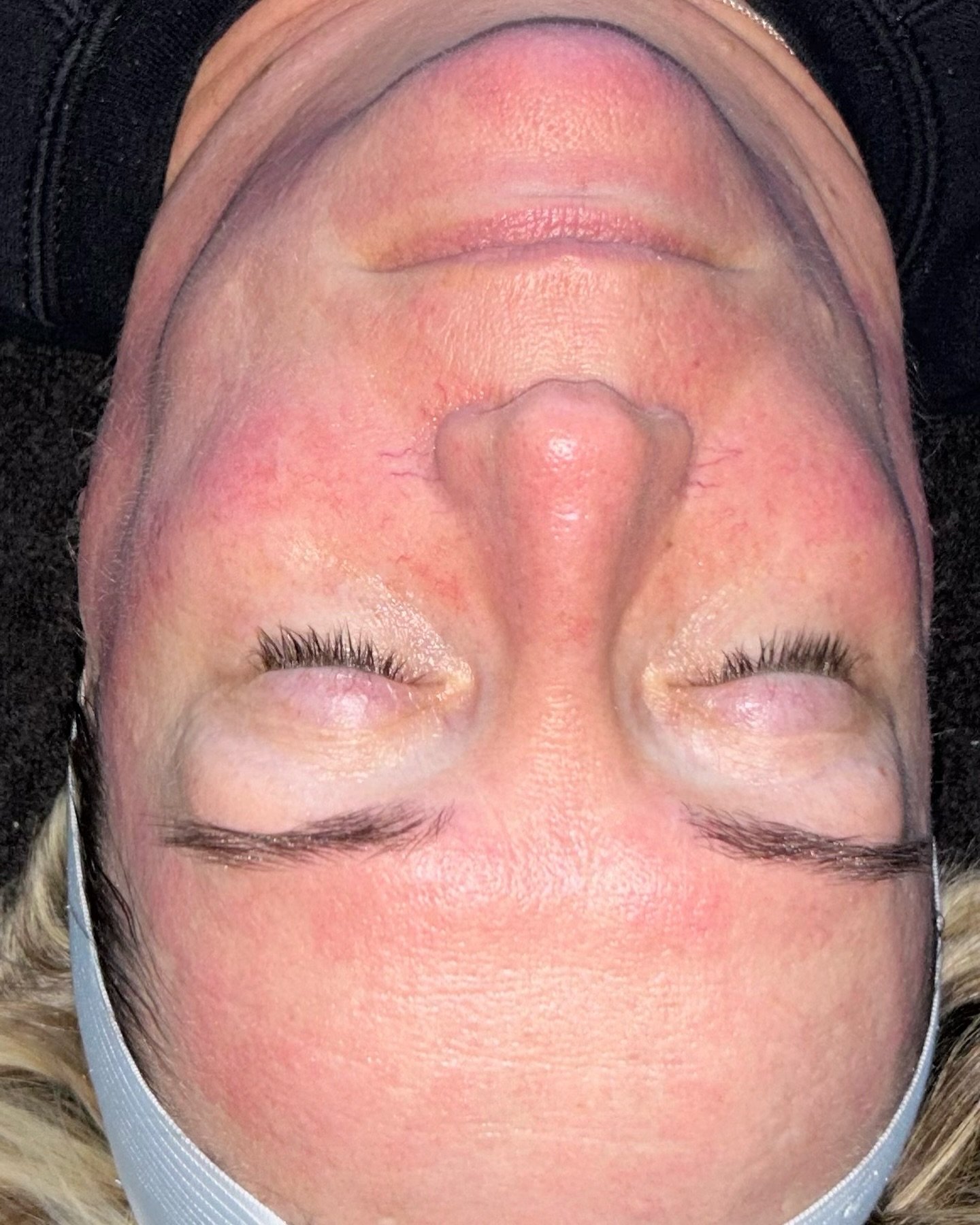 Collagen Renewal for a regular client 💉

Microneedling is your new BFF 👭

Gives you a healthy glow 
Stimulates collagen production 
Improves elasticity 
Reduces fine lines and wrinkles 
Reduces facial scarring 
Minimises enlarged pores 
Lightens hy
