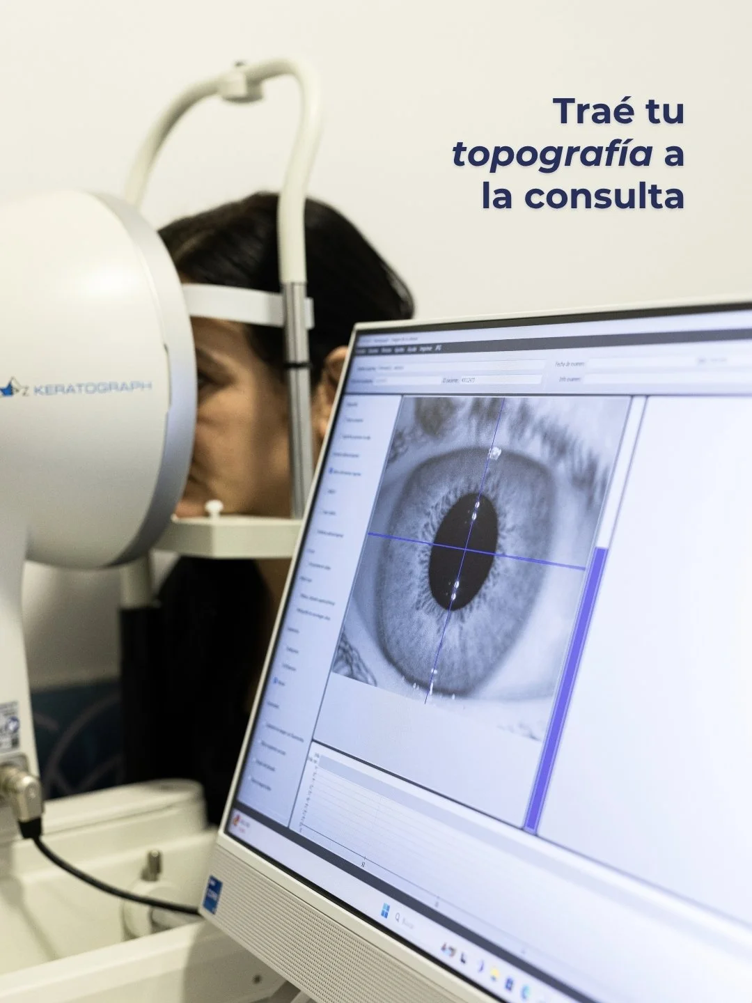 Cada vez que decimos "tra&eacute; tu topograf&iacute;a", hablamos de esto.
Es un estudio simple, r&aacute;pido y no invasivo, que le da al equipo m&eacute;dico la informaci&oacute;n real sobre el estado de tu c&oacute;rnea y es la base para