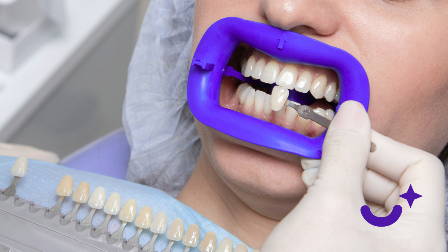 Bonding vs. Veneers: Choosing the Best Fix for Chipped Teeth.