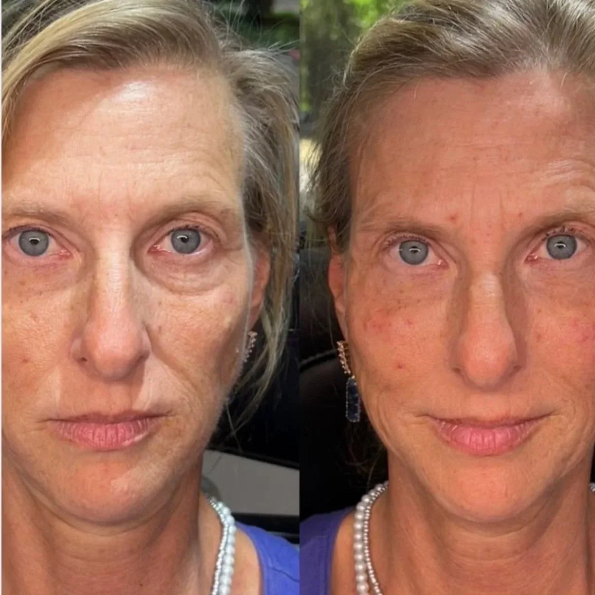 Liquid Face Lift