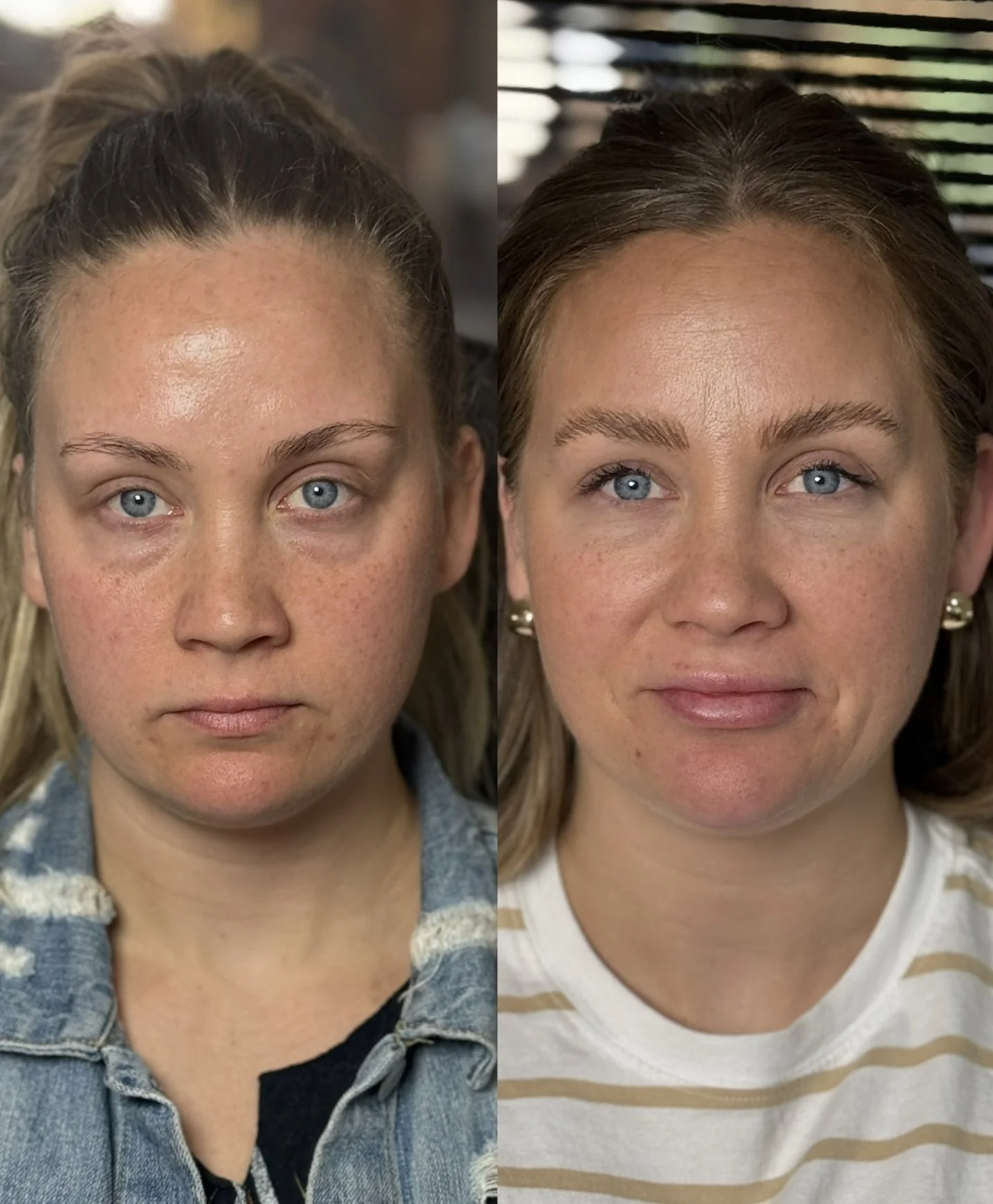  Transform your look with a non-surgical facelift. Our expertly placed dermal fillers restore volume and contour for a youthful, lifted appearance. 
