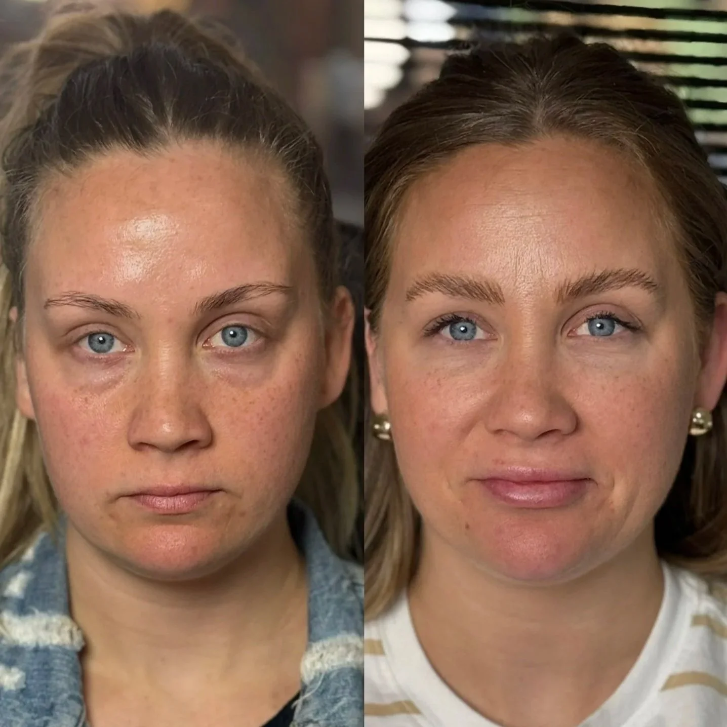 Liquid Face Lift