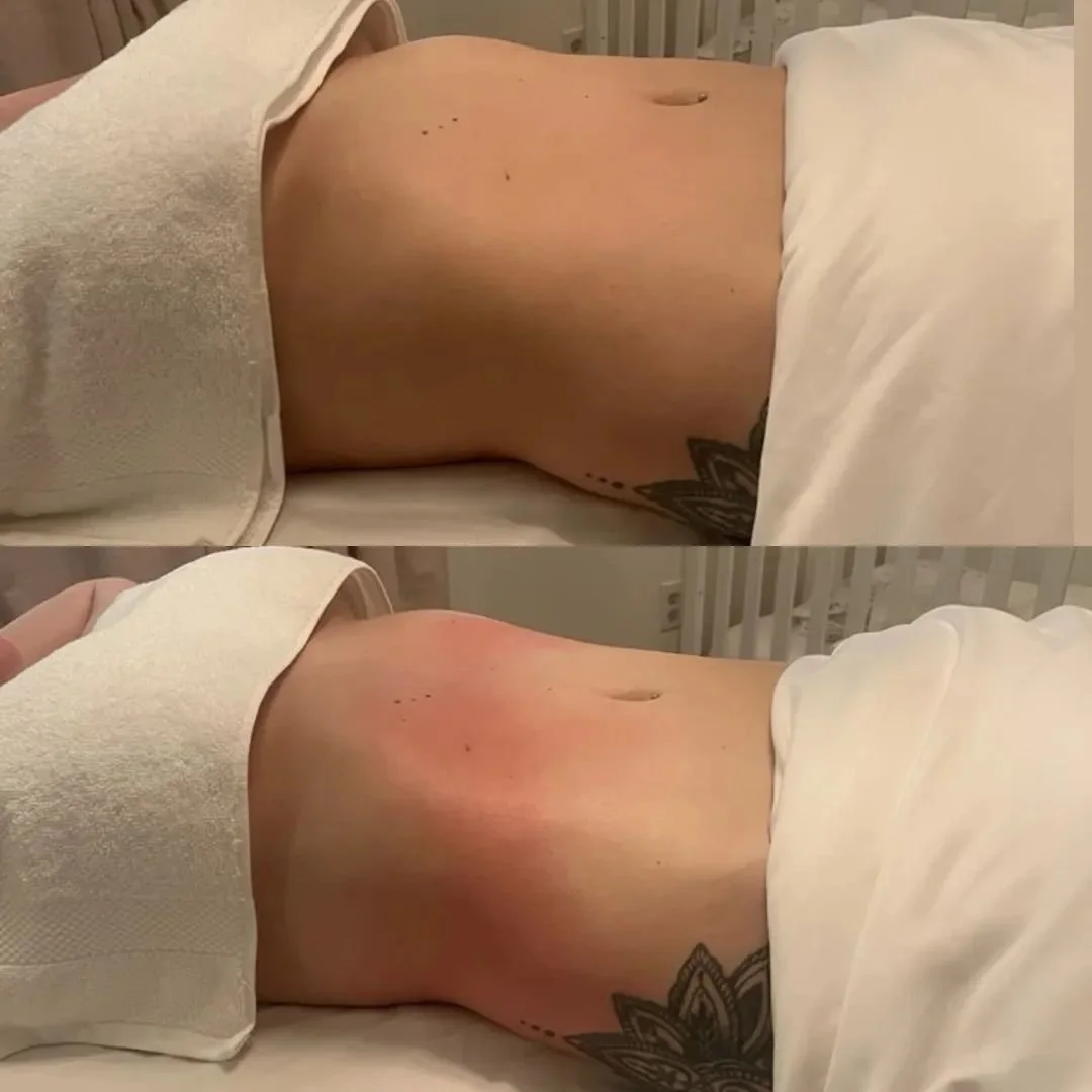 Postpartum Treatment💧

This treatment helps reduce fluid retention and tightens the skin, which can lessen the appearance of stretch marks. It also relieves stress and promotes relaxation 💫
 

 #lymphaticdrainage  #lymphaticmassage  #wellness #post
