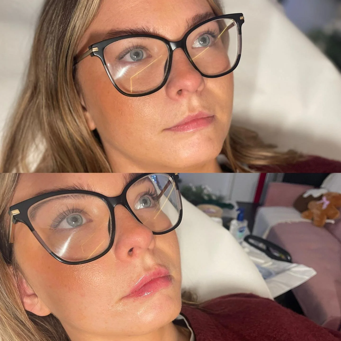 ✨ Subtle Lip Filler Magic ✨

This gorgeous client came in for her first lip filler treatment and was looking for a very small amount of change, just a little extra shape and volume to enhance her natural lips. 💋

At our clinic, we specialise in subt