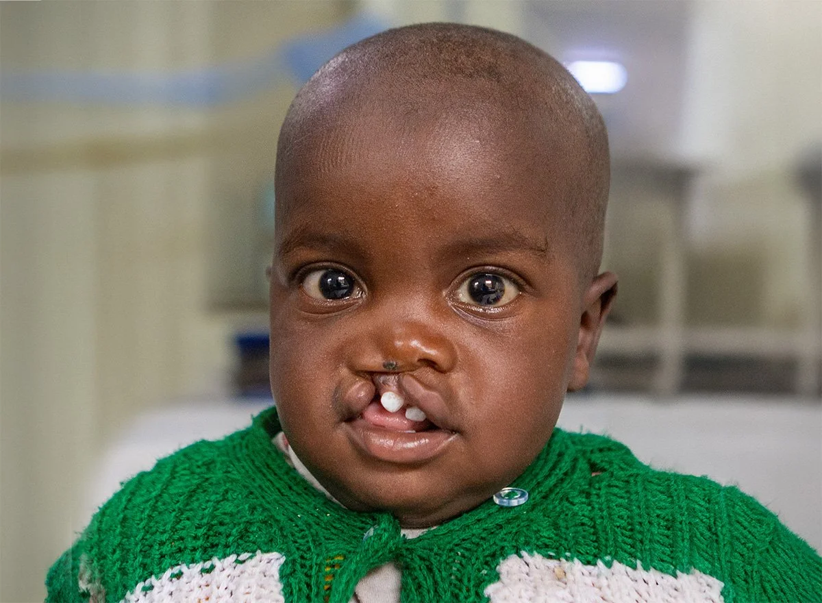 Smiles Restored: Cleft Surgery Begins at CURE Malawi