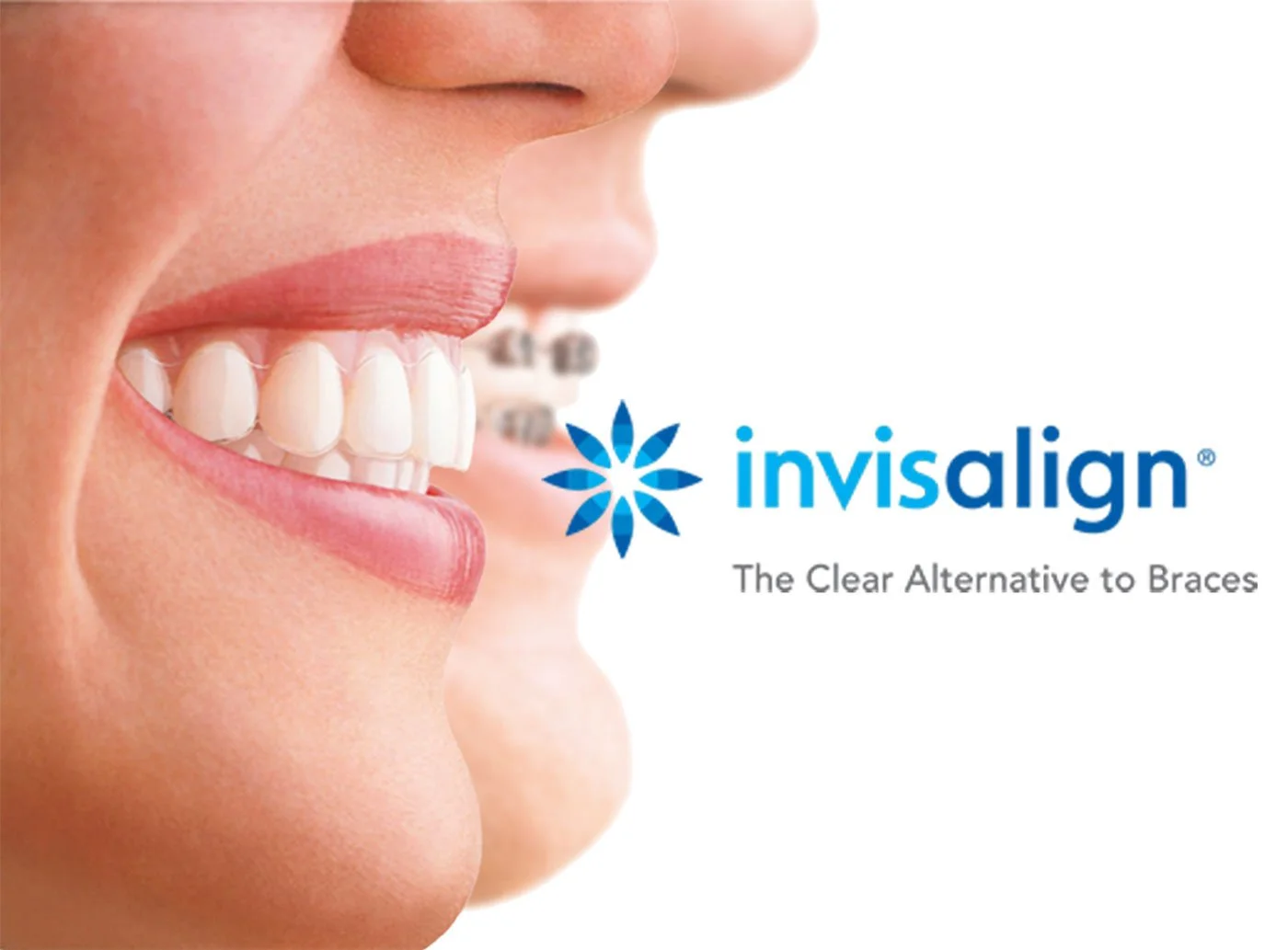 What Is The Science and Technology Behind Invisalign?