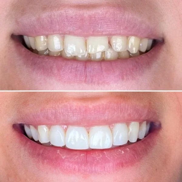 Can Composite Bonding Damage Your Teeth in the Long Term?