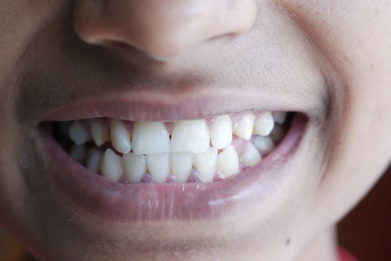 Can Invisalign Help With Teeth Grinding?