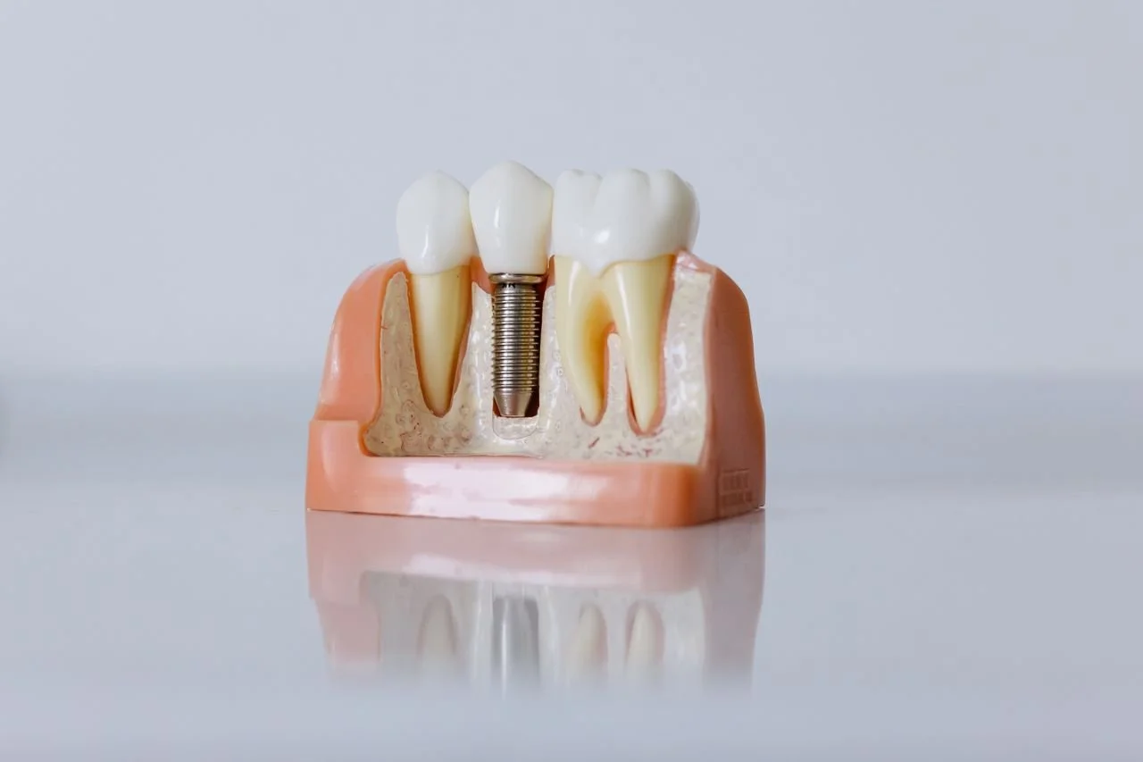 How Long Does Dental Implant Treatment Take?