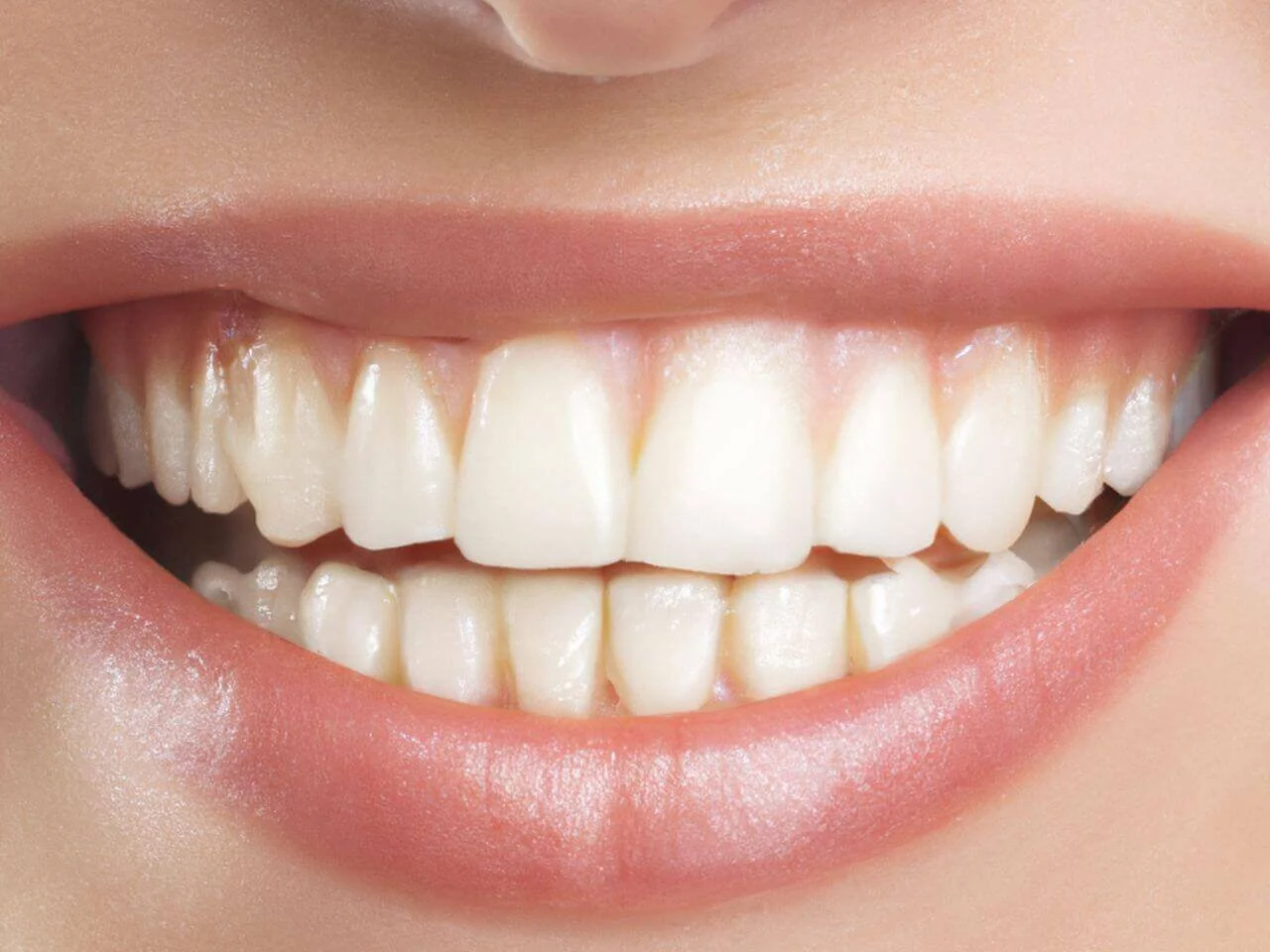 Teeth Whitening Home Kits vs Professional Whitening