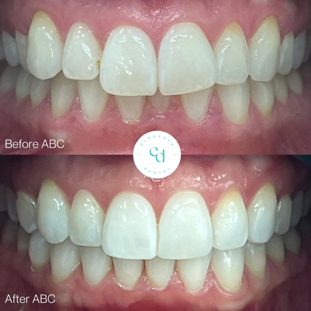 ⭐️ BEFORE &amp; AFTER: Align, Brightening, Composite Bonding ⭐️ 

WOW! Laura&rsquo;s dream smile, brought to life! ✨

Thinking about your own dream smile? Feel free to contact us:
✨ BOOK YOUR FREE CONSULTATION via the link in our bio

✨ CALL US on 01