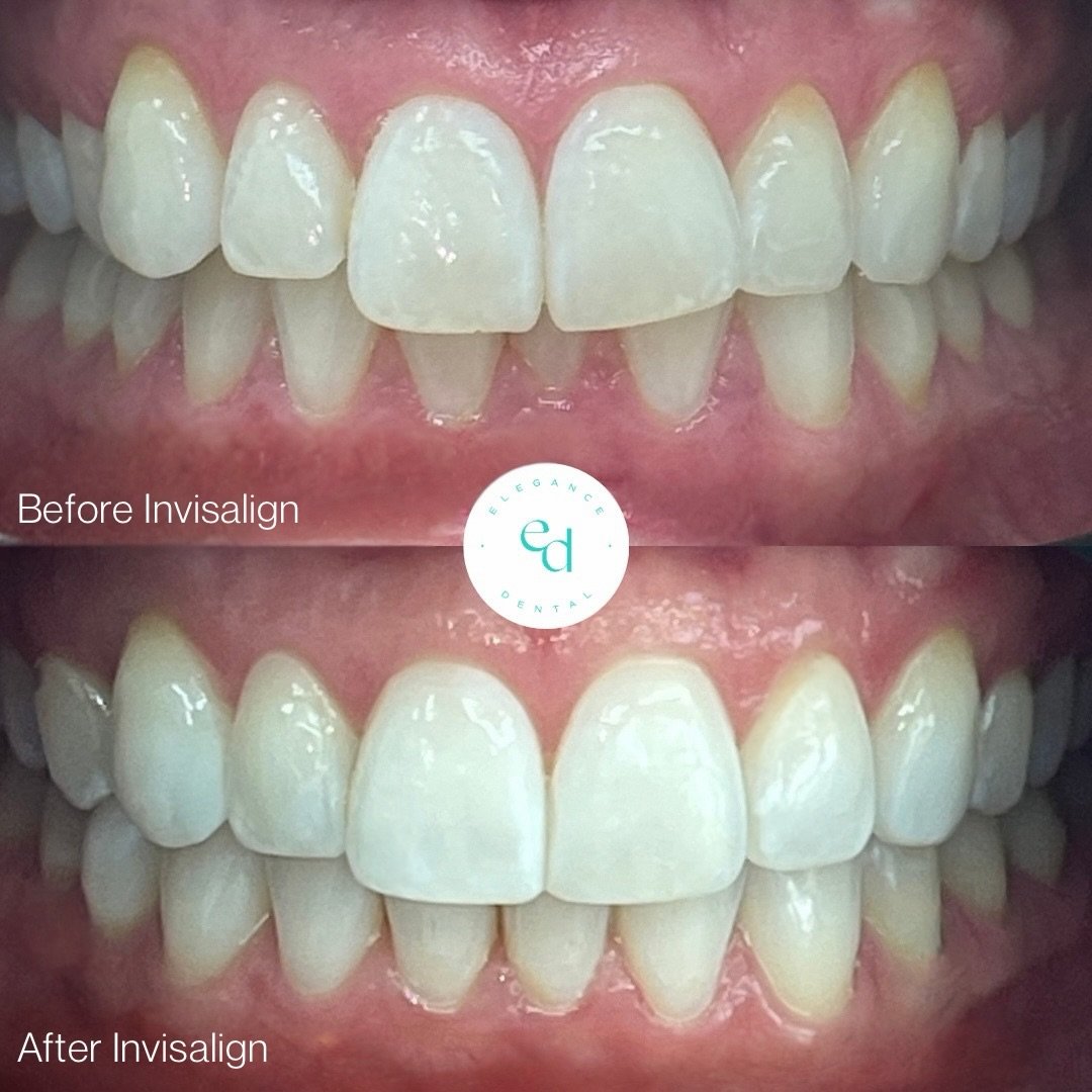 🤩 INVISALIGN SEPTEMBER SALE 🤩

Just look at this incredible before &amp; after! ✨ Imagine what your dream smile could look like&hellip;

Our Invisalign Open Days are THURSDAY 10th &amp; FRIDAY 11th SEPTEMBER!

✨ &pound;200 OFF Invisalign treatment
