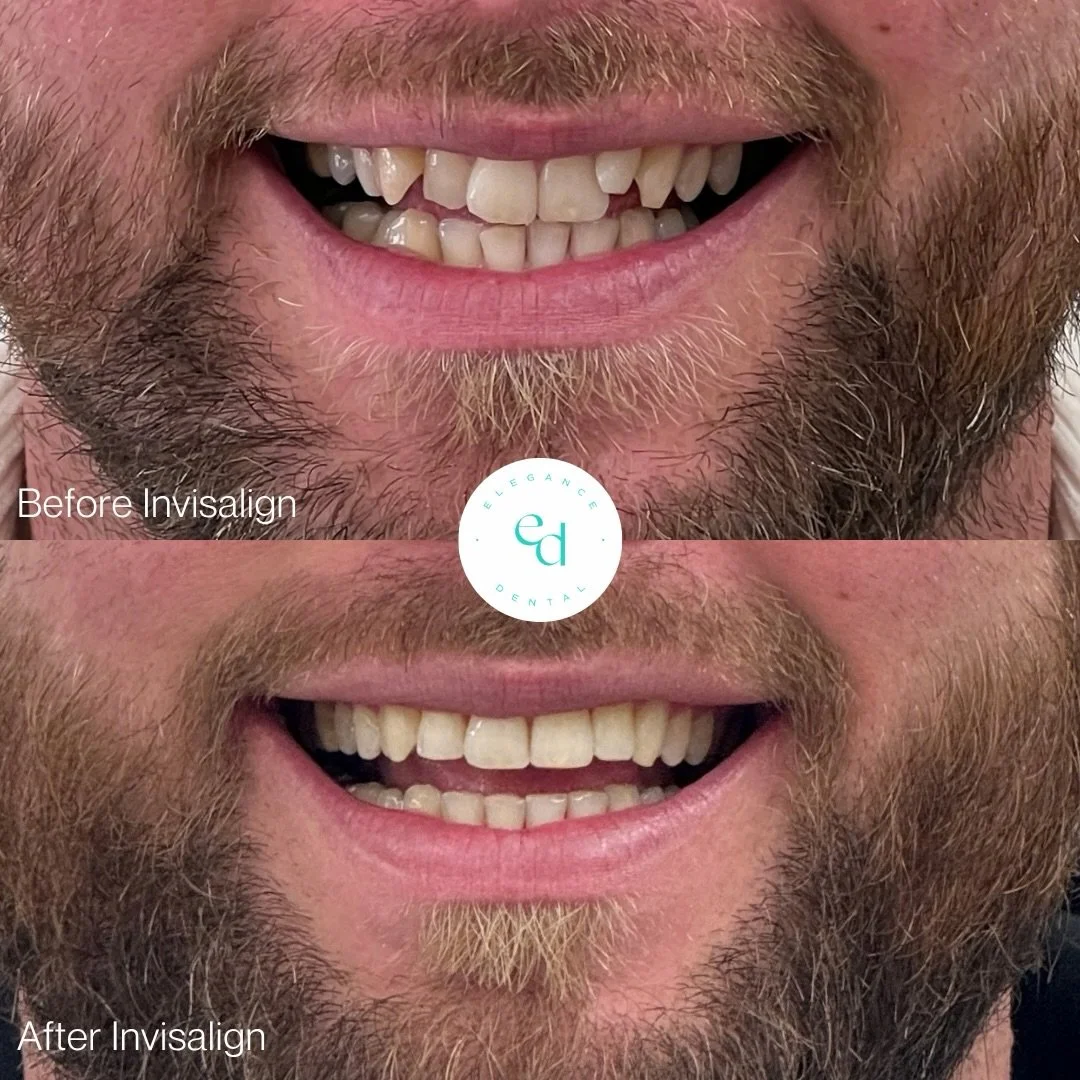 ⭐️ BEFORE &amp; AFTER: Invisalign ⭐️ 

Let&rsquo;s take a moment for Harry&rsquo;s amazing smile transformation! 😍🦷

Ready for your dream smile? CONTACT US!

✨ BOOK YOUR FREE CONSULTATION via the link in our bio

✨ CALL US on 01920 821579

✨ DM US
