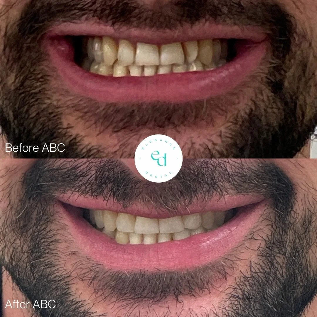 ⭐️ BEFORE &amp; AFTER ABC! ⭐️

Align + Brighten + Composite Bonding = Matthew&rsquo;s amazing smile transformation! 

Ready to start your DREAM smile transformation before 2027? 💫

✨ BOOK YOUR FREE CONSULTATION via the link in our bio

📞 CALL US: 0