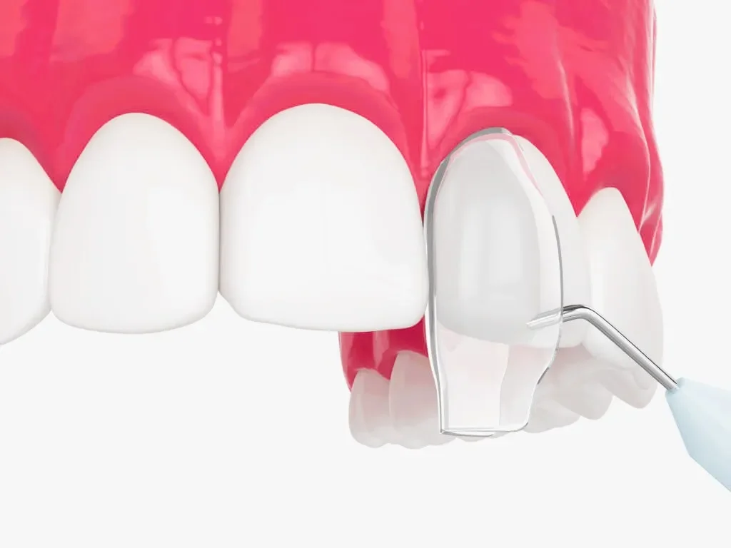 Can You Combine Invisalign and Composite Bonding?