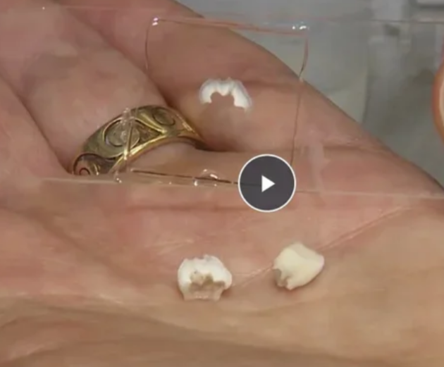 Two teeth sitting in a hand