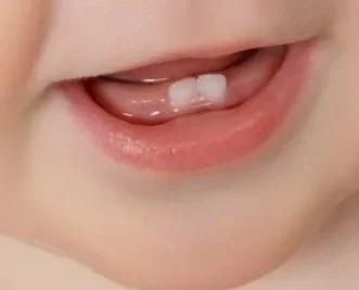 Close up of a baby's mouth with two bottom teeth