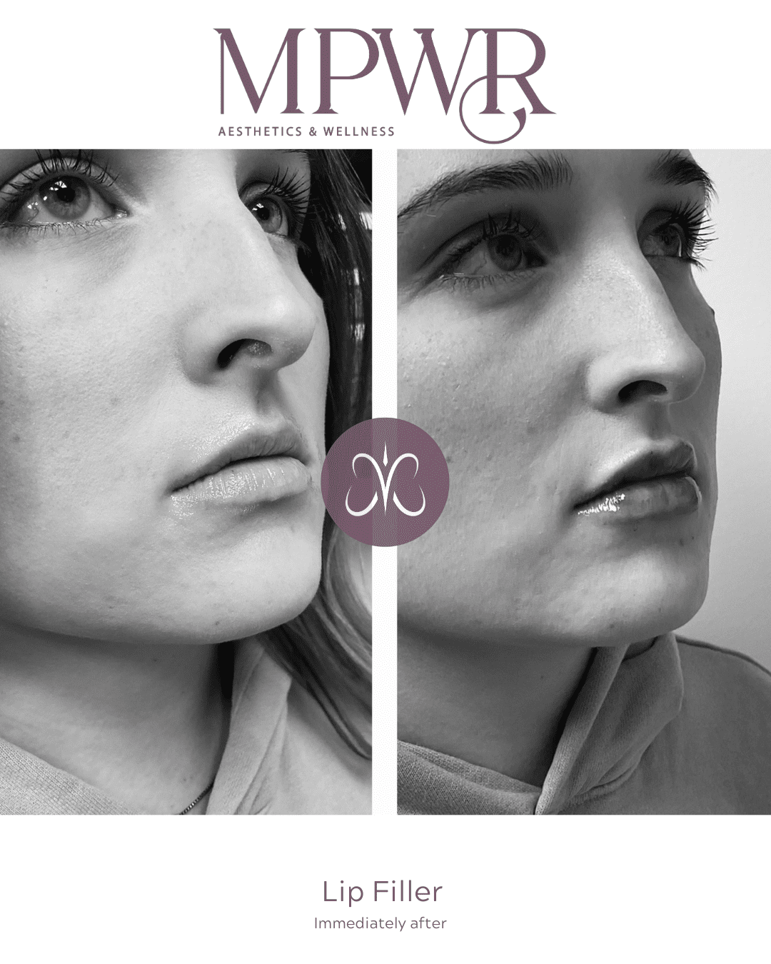 lip filler before and after