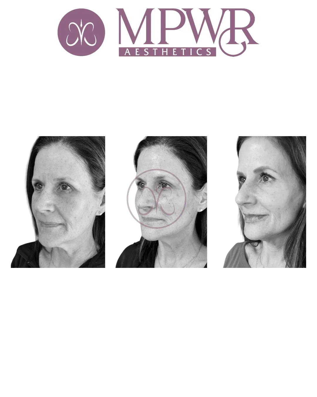 Black and white before-and-after photo collage of a woman showing facial improvements from aesthetic treatments, with a logo for MPWR Aesthetics at the top.
