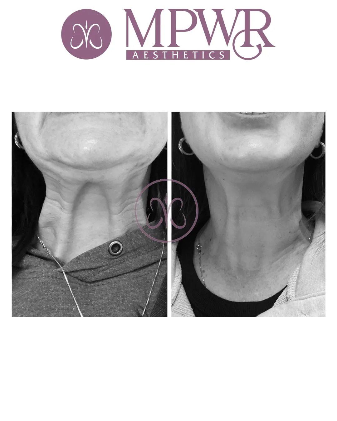 Before and after comparison of a woman's neck showing reduction of loose skin after aesthetic treatment at MPWR Aesthetics.