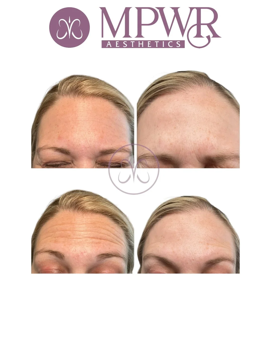 Before and after a woman forehead with DYSPORT tox treatment