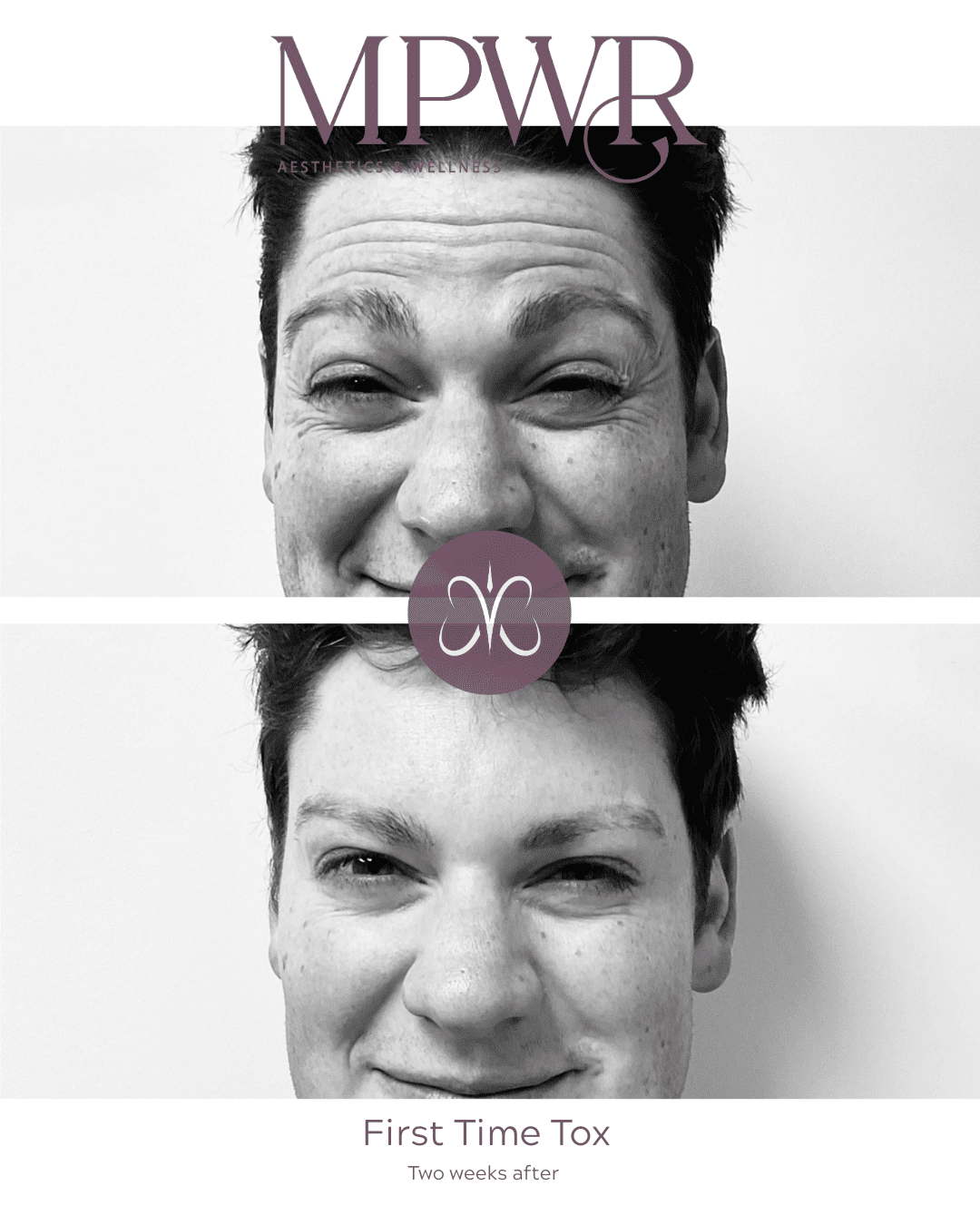 botox for men