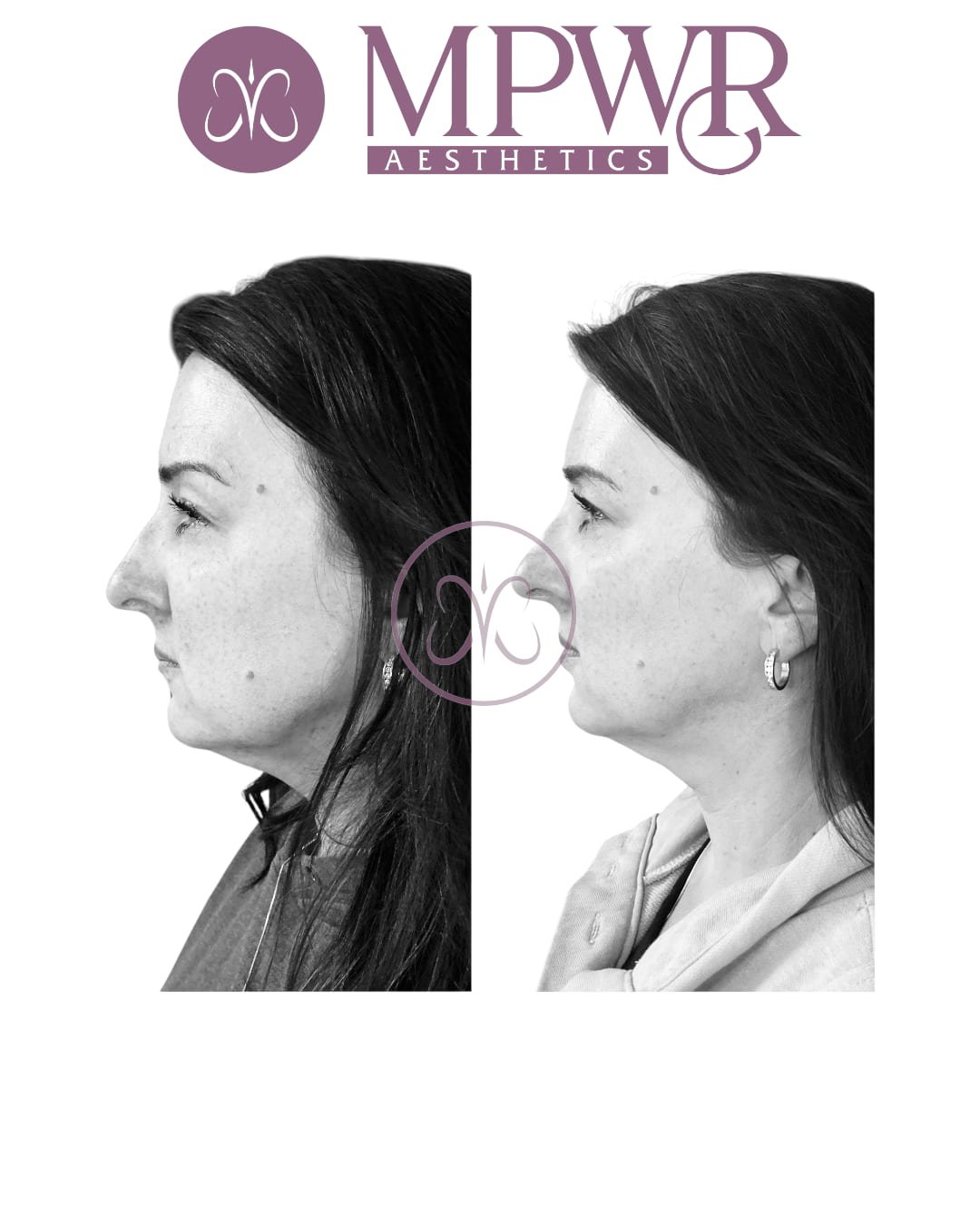 Side profile picture of neck band neurotoxin treatment