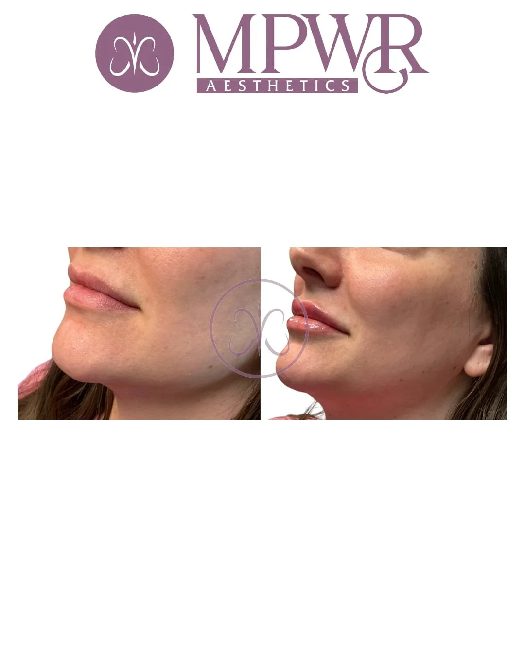 Lip, filler lip plump, hyaluronic acid lip, filler