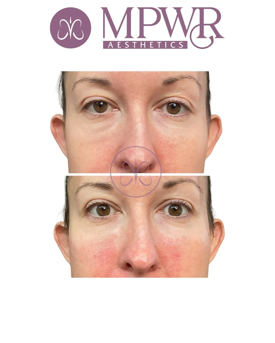 Mid face rejuvenation, and under eye filler before and after