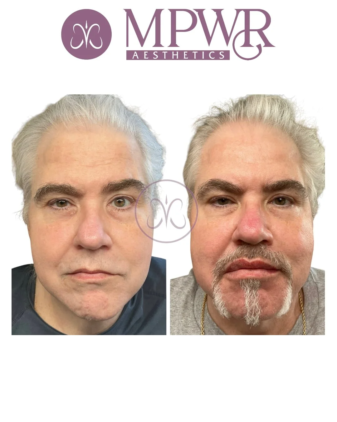 Male ip filler before and after