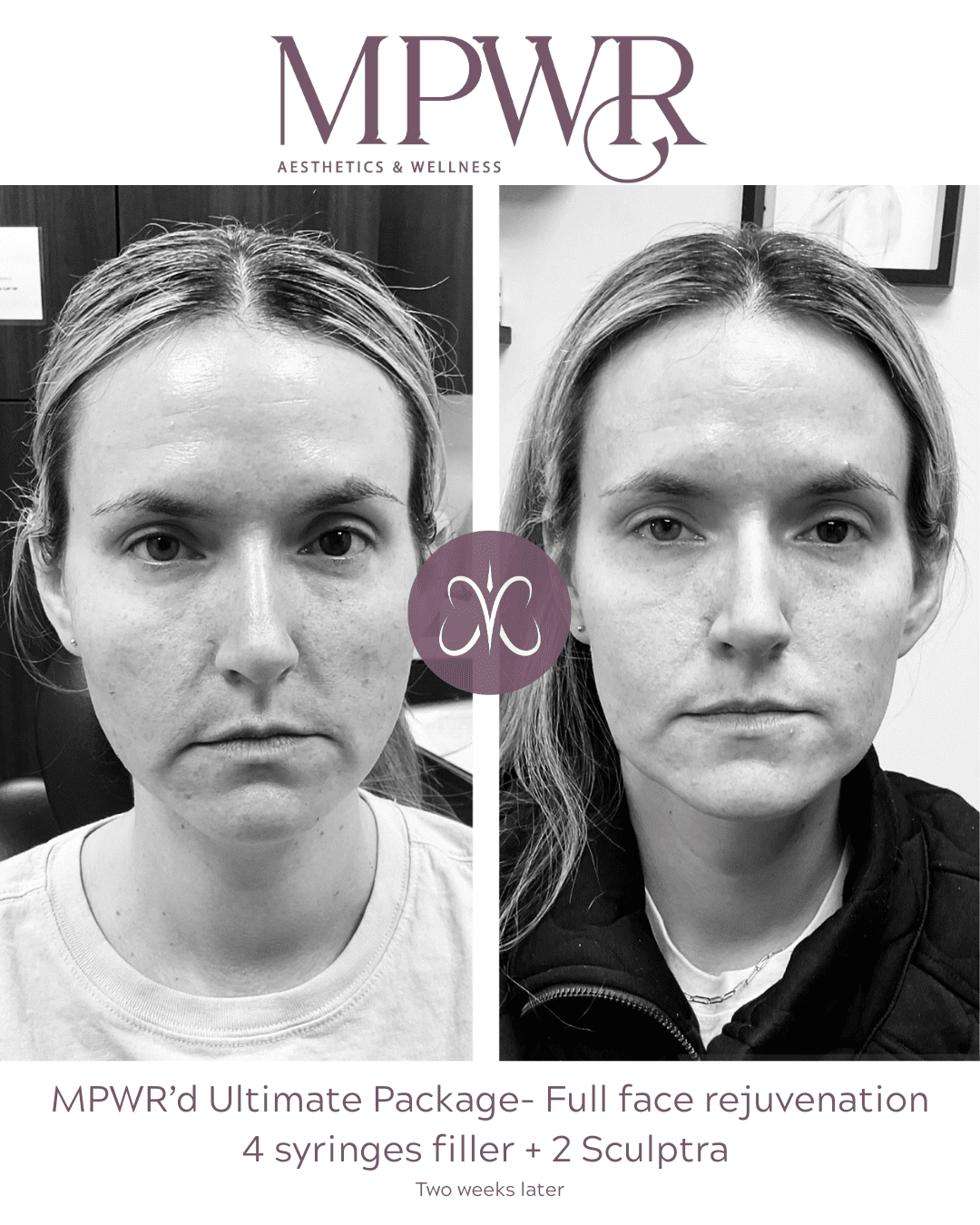 cheek filler midface filler