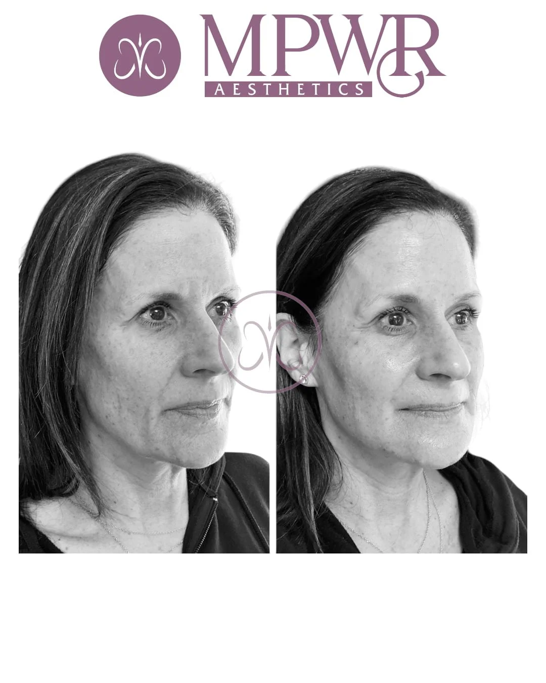 Side-by-side black and white photos of a woman before and after aesthetic treatment, with the logo of MPWR Aesthetics above.
