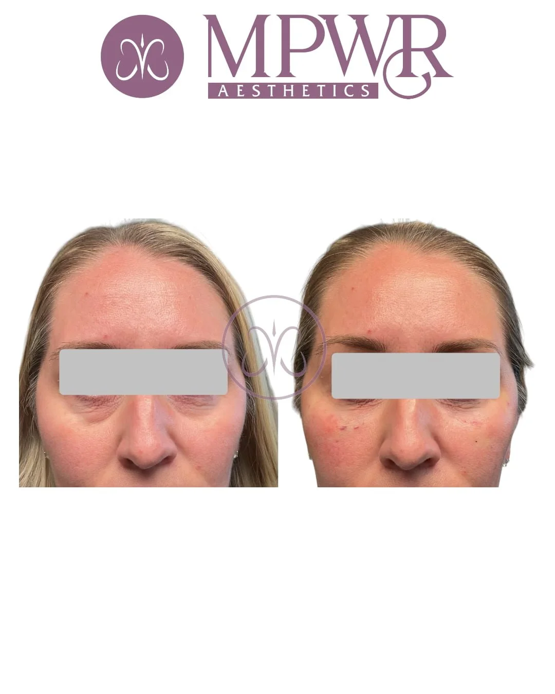 Undereye rejuvenation