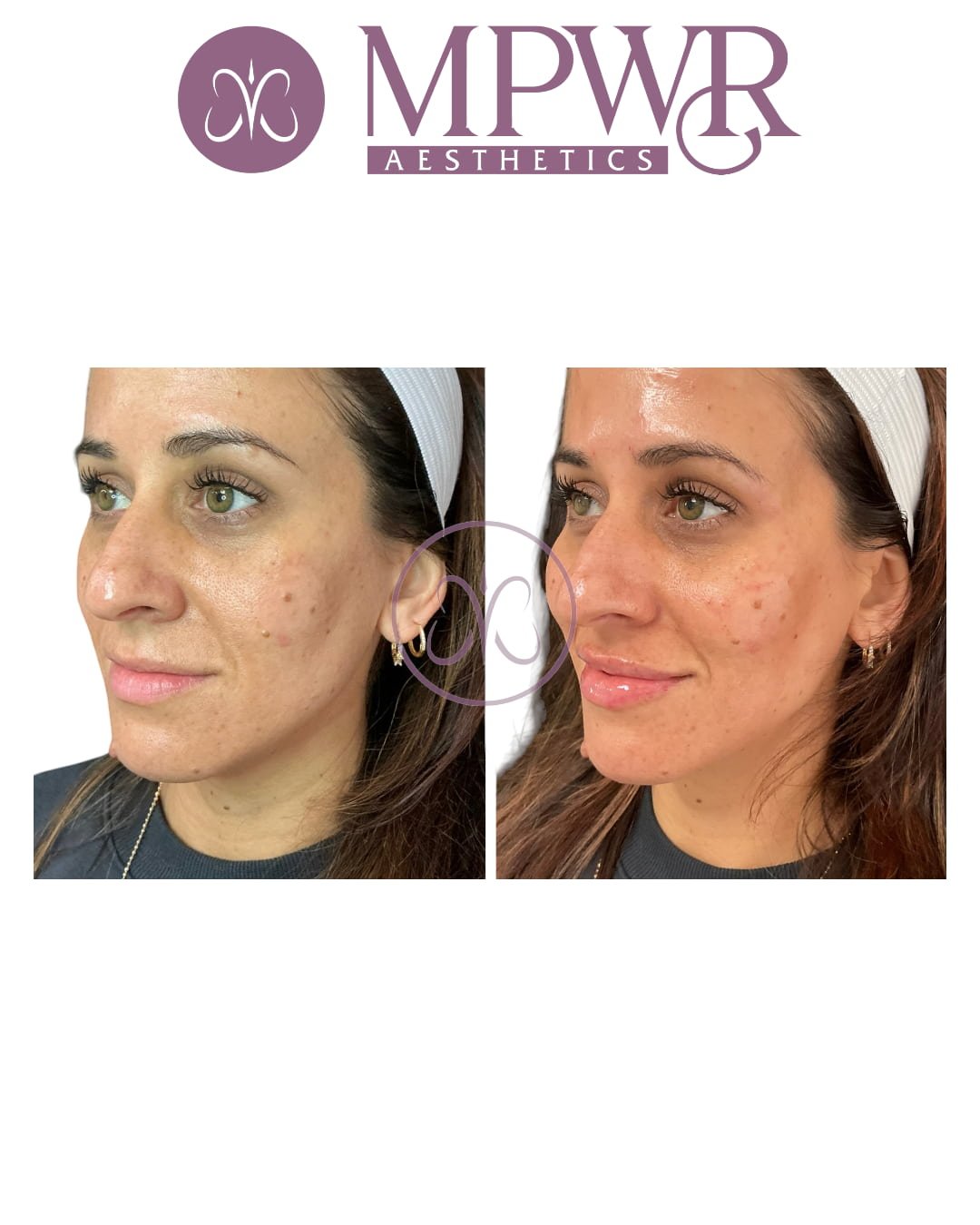 Facial balancing before and after lip, filler and cheek filler