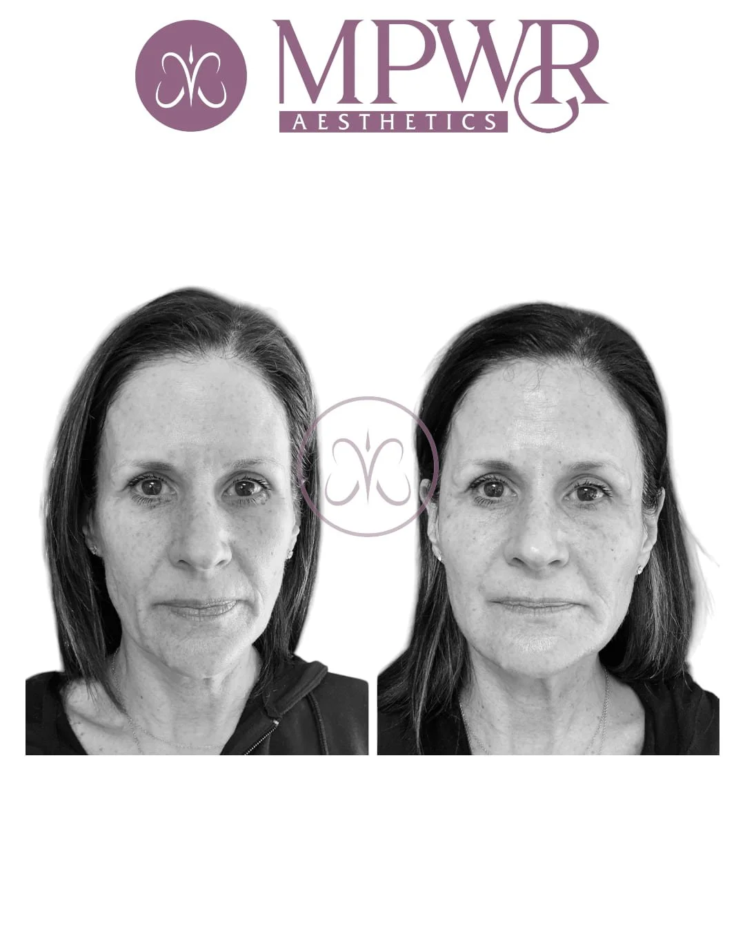 Side-by-side black and white before-and-after photos of a woman, showing smoother skin and reduced wrinkles after aesthetic treatment, with the MPWR Aesthetics logo at the top.