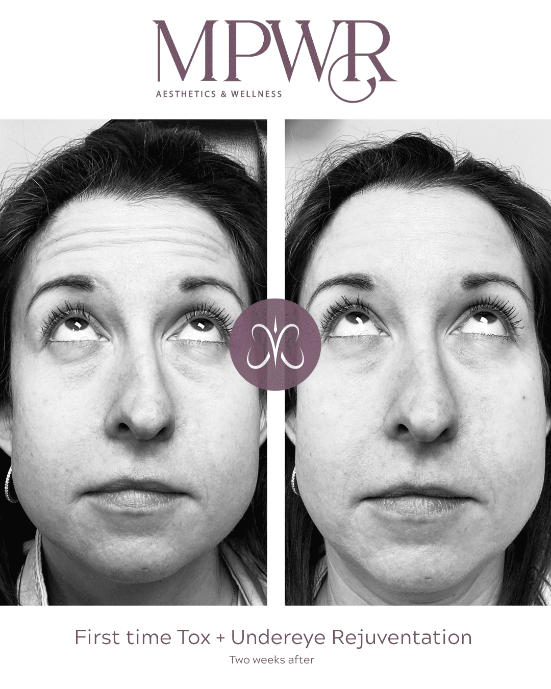 undereye rejuvenation prf tox