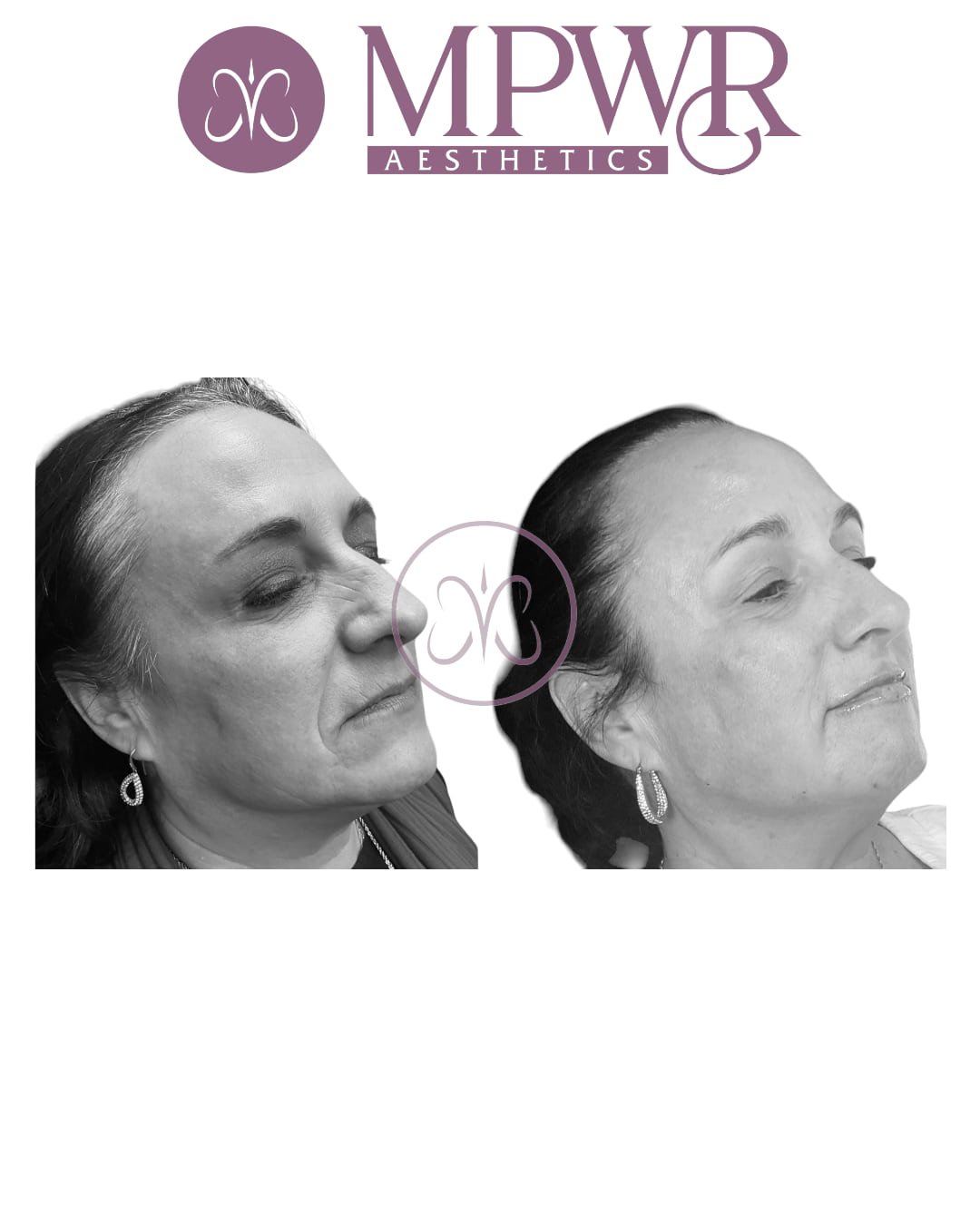 Full face rejuvenation with RADIESSE and RESTYlaneE hyaluronic acid filler