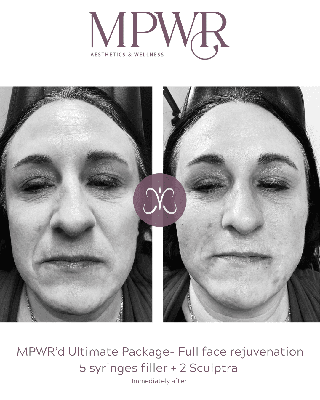 full face rejuvenation with filler biostimulator