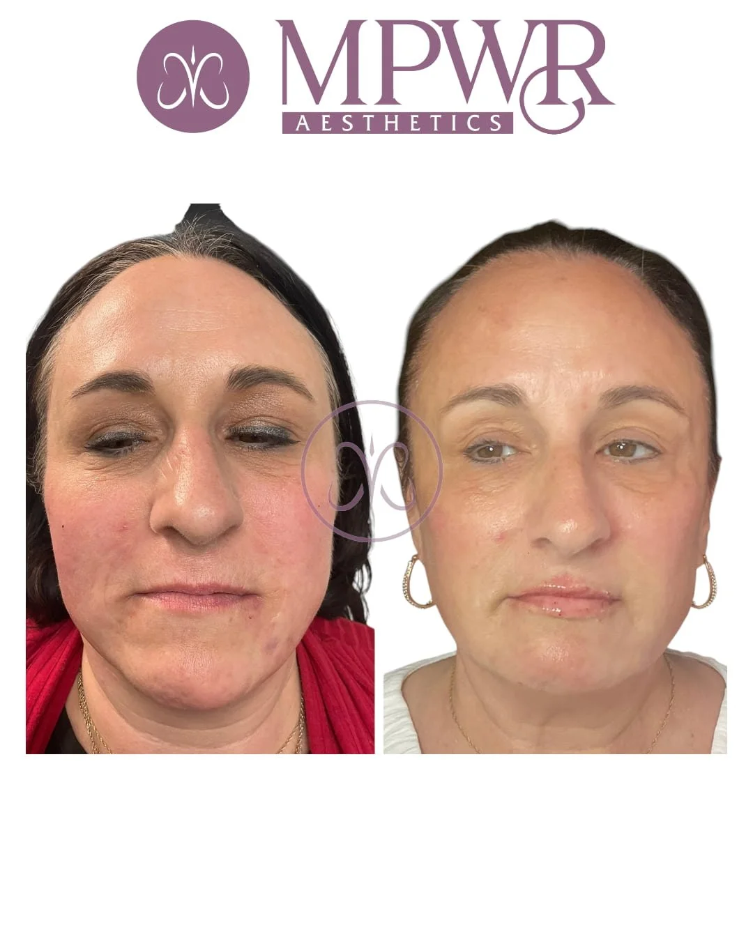 Full face by a simulator and filler treatment