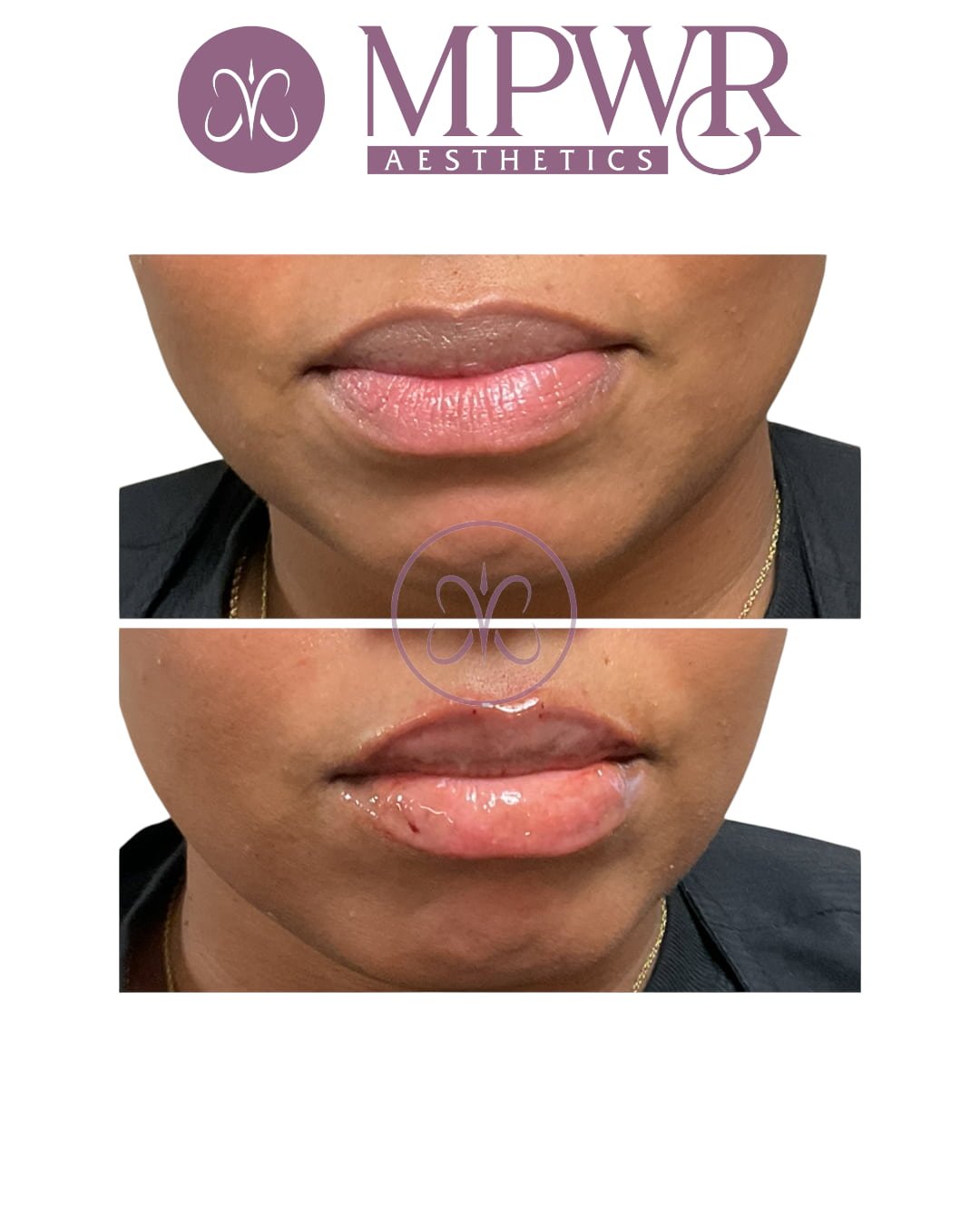 Before and after images of lips showing the results of aesthetic lip enhancement, with the logo of MPWR Aesthetics at the top.