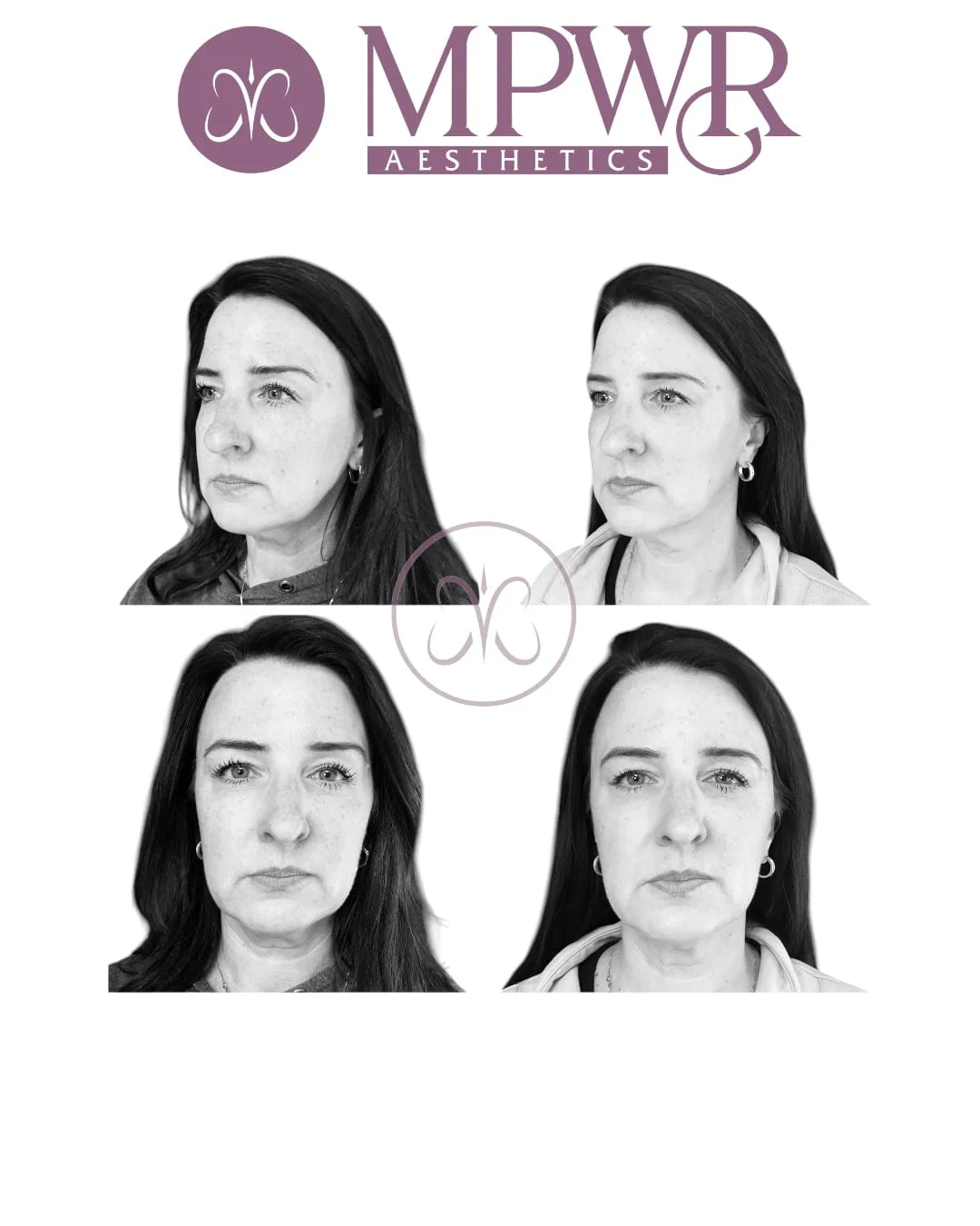 Before and after photos of a woman showing facial improvements from MPWR Aesthetics treatments, with the MPWR Aesthetics logo at the top.