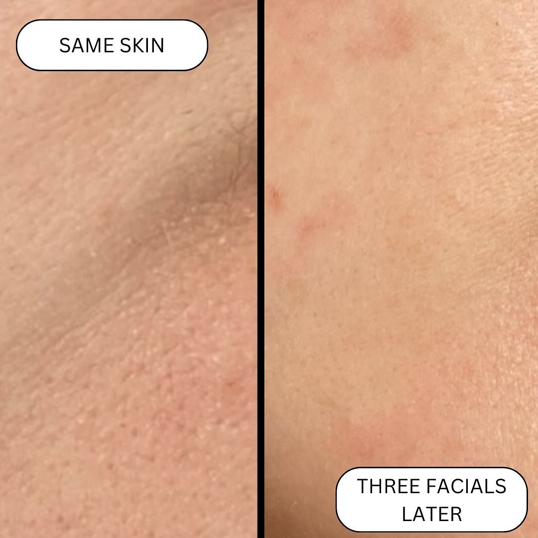 Texture - Smooth 🧴
Pores - Minimized 🕳️
Skin - Glassy 🍷