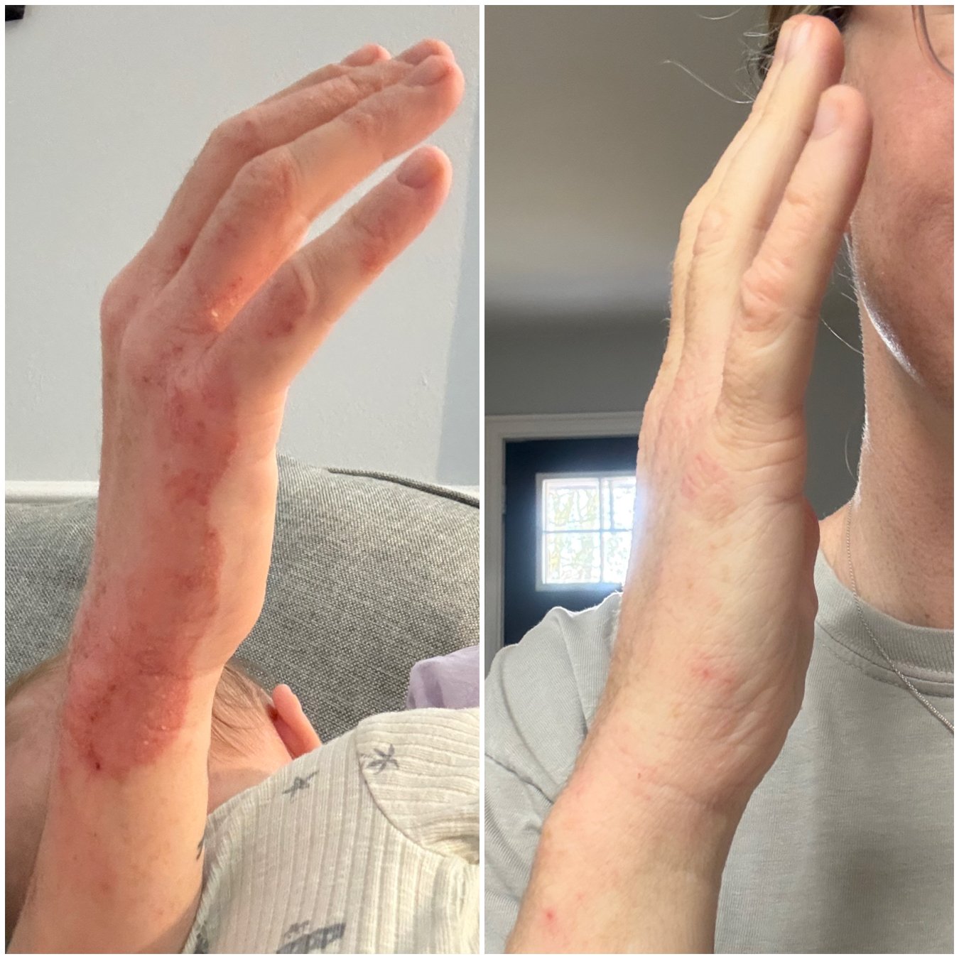 Dyshidrotic Dermatitis natural healing